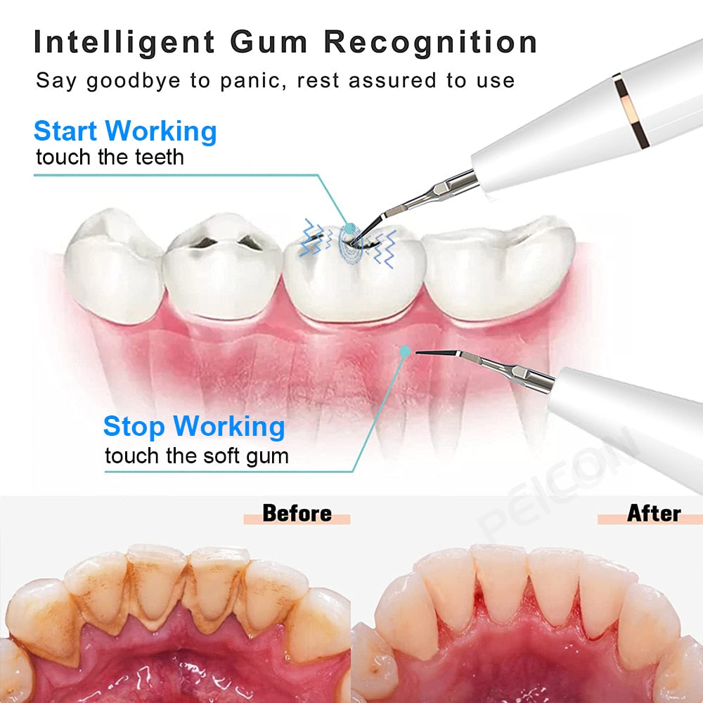 Ultrasonic Dental Stain and Plaque Remover Prily